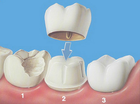 couronne dentaire 3 Dental Prosthesis: Cosmetic Tour