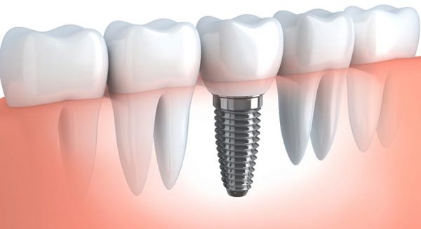 implant-dentaire-Tunisie implant dentaire en Tunisie : Chirurgie dentaire